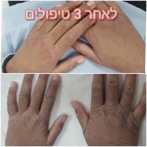 אטופיק ידיים