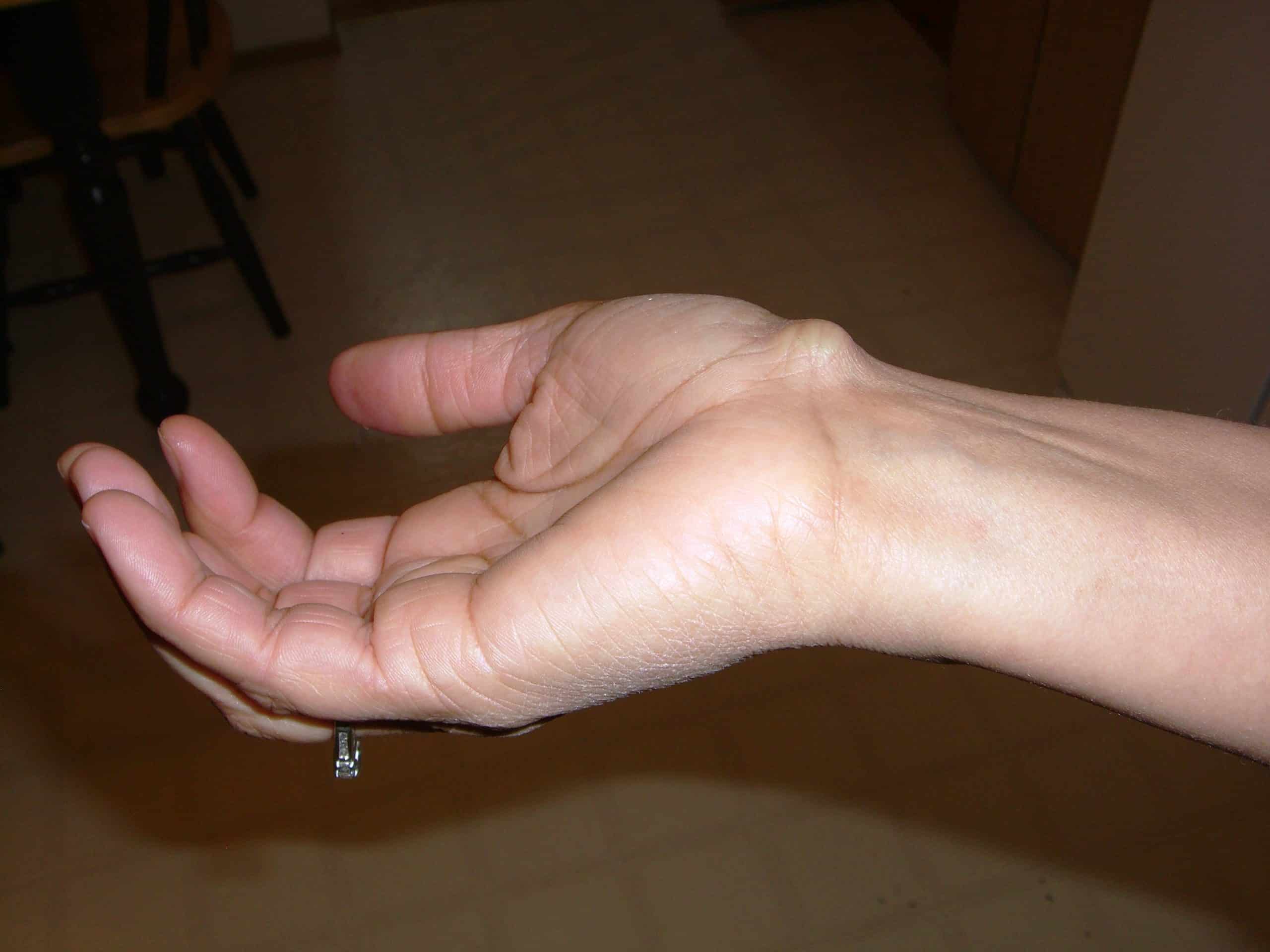 Cyst Profile2 scaled