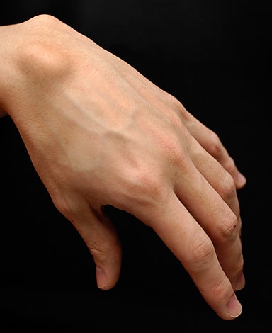 Ganglion cyst